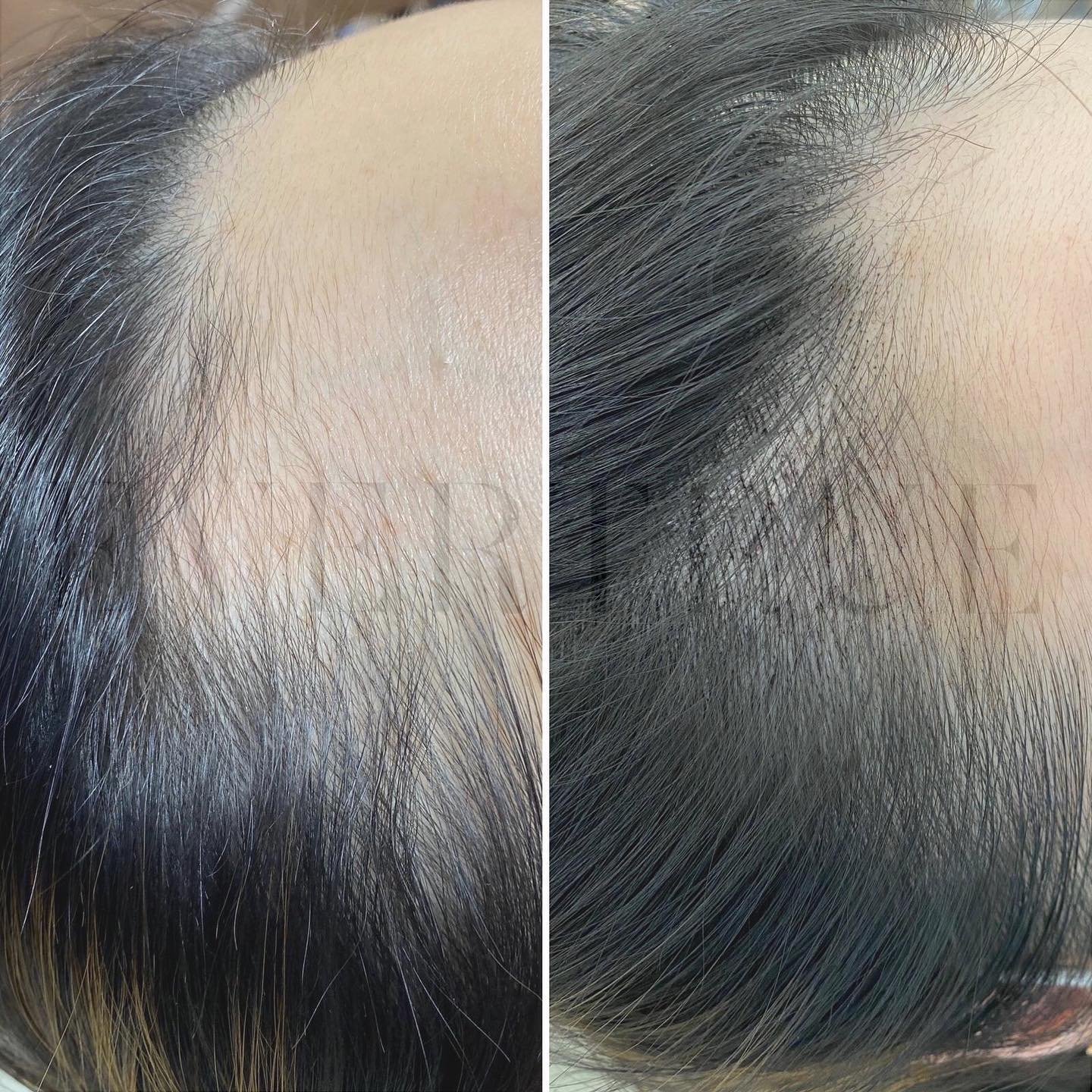 Before and After Hairline Microbalding 